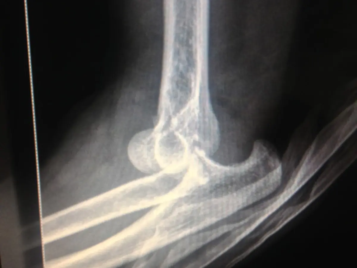 Osteosíntesis de tobillo