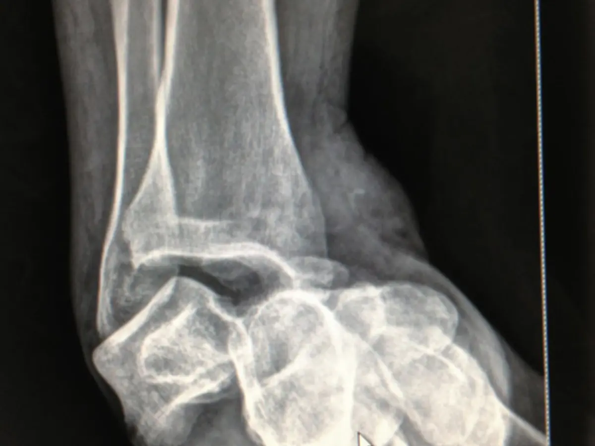Artroplastia de cadera