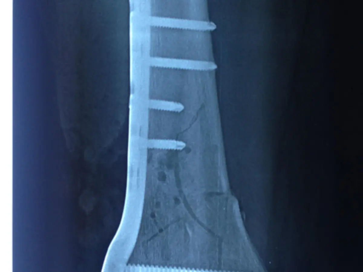 Osteosíntesis de tibia
