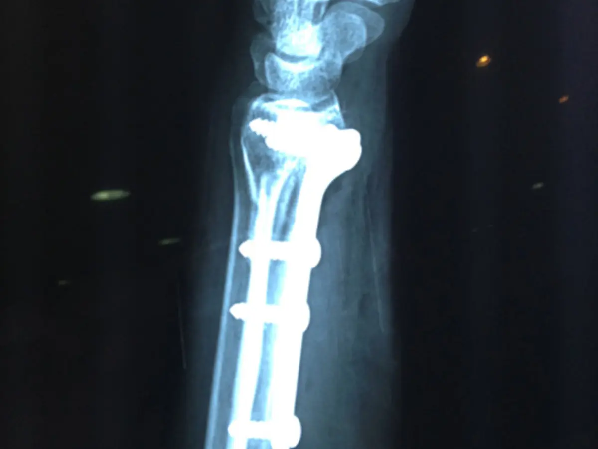 Pelvis: fijación compleja