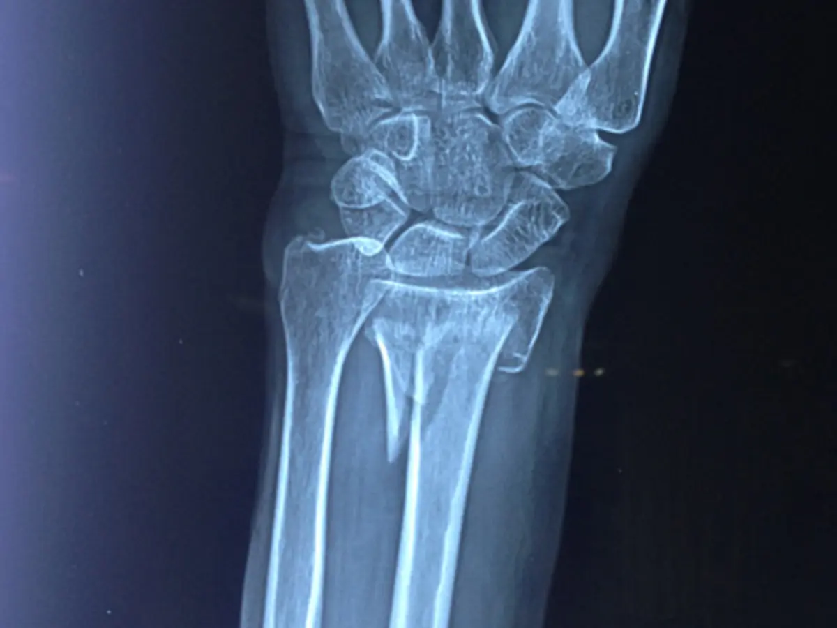Control de fractura de muñeca