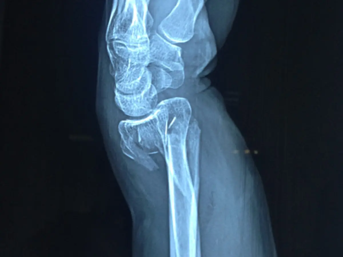 Valoración de rodilla