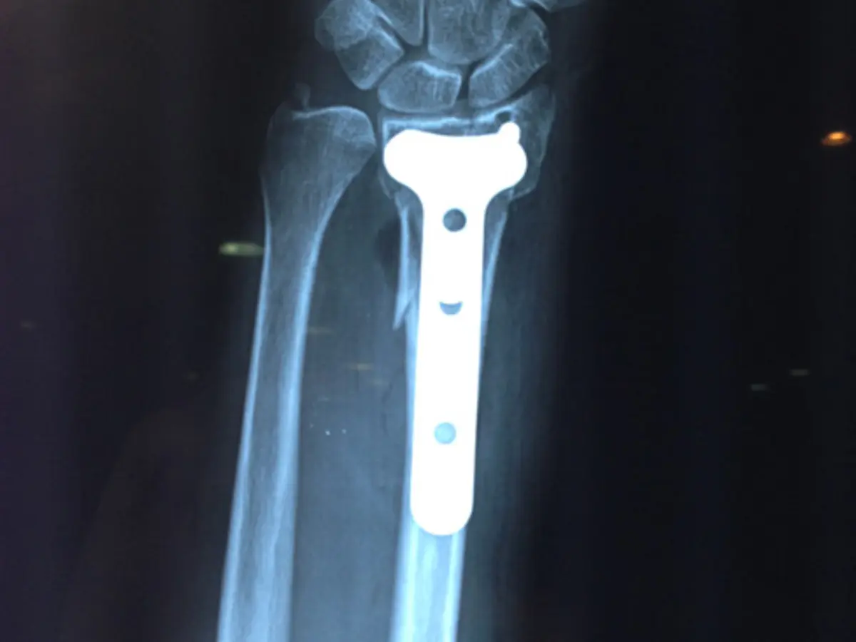 Fijación de rodilla con clavo
